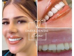 what-is-dental-veneer-and-how-is-it-done